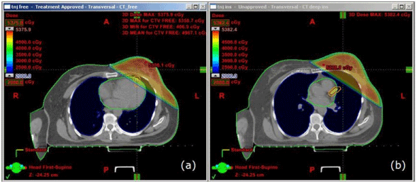 Herzschonung bei links-seitigem Brustkrebs durch Atem gesteuerte Bestrahlung