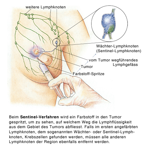 In der achsel knoten Inwiefern kann