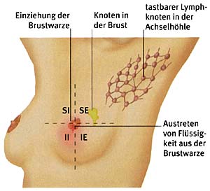 Brustkrebs Symptome