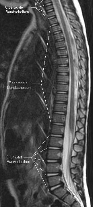 Tumore der Wirbelsäule