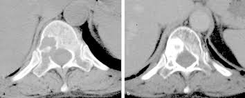 Knochenmetastase behandlung