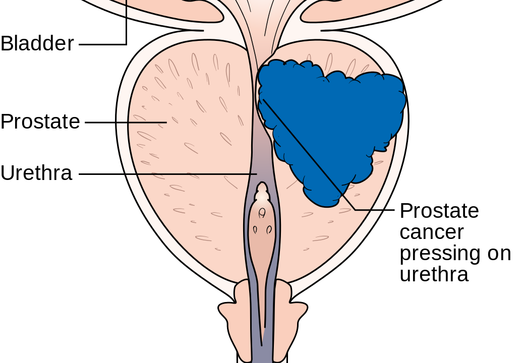 Metastasierter Prostatakrebs – Änderung der Zulassung für Abirateron ( Zytiga ®)