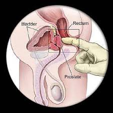Prostatakrebs Vorsorgeuntersuchung
