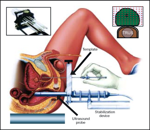 Brachytherapie bei Prostatakrebs