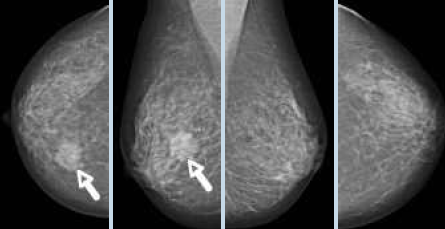 brustkrebs mammographie