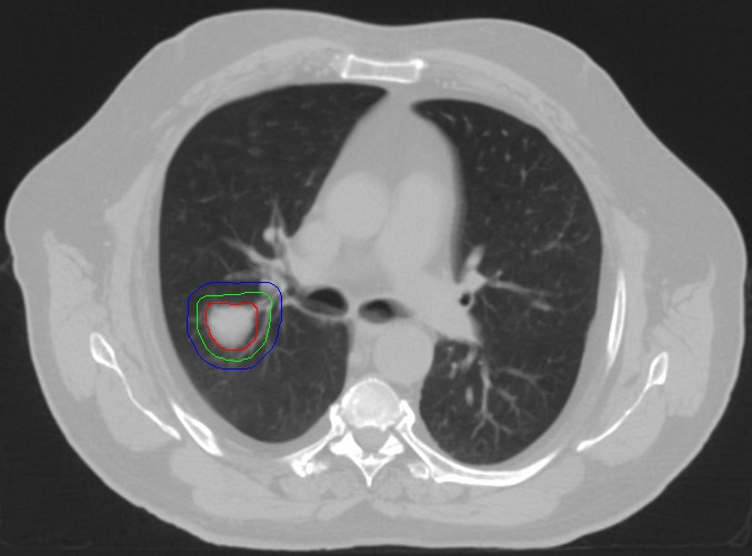 Stereotaktische Bestrahlung bei Lungenkrebs