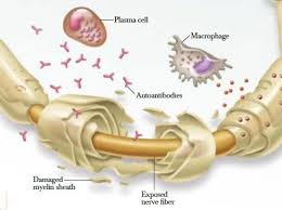 neuropathie 1